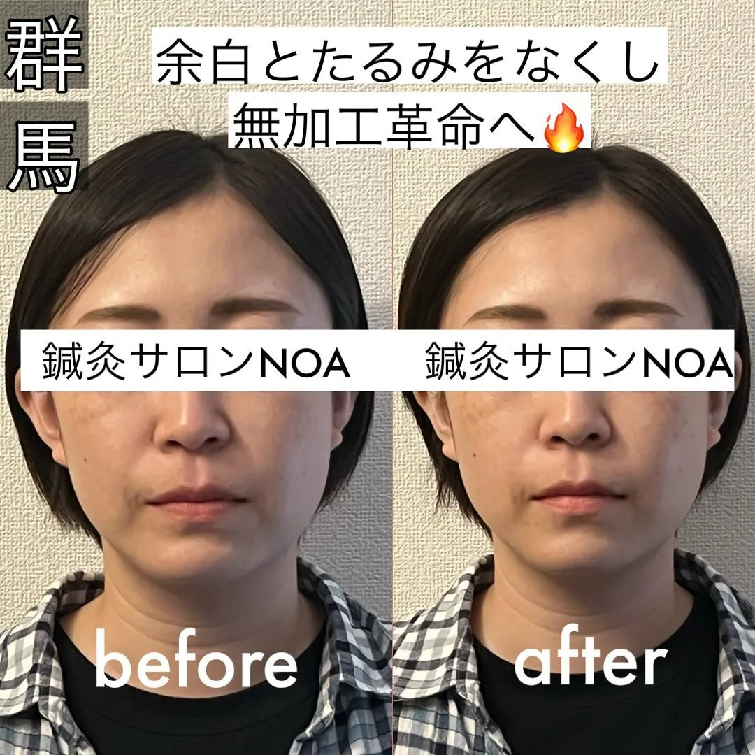 （伊勢崎小顔矯正）　　before after